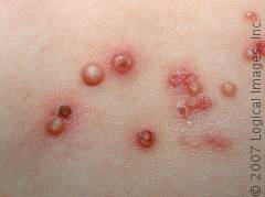 Another type of Molluscum Contagiosum.jpg