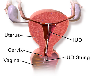 Blausen 0585 IUD.png