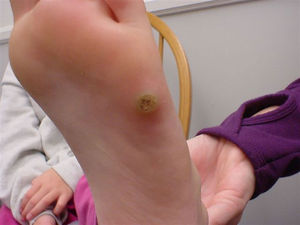 Molluscum Contagiosum on foot.jpg