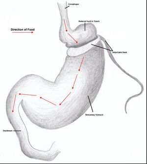 Gastricbanding.jpg