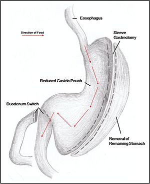 Duodenal.jpg